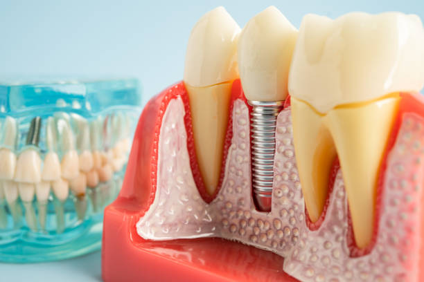 Best Root Canal Treatment  in Lake Brownwood, TX